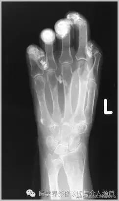 软组织钙化是不是骨化性肌炎,软组织钙化或骨化