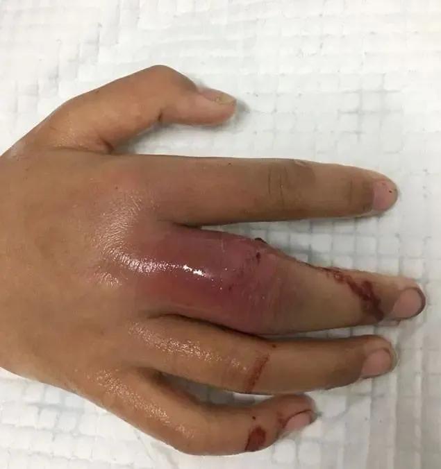 19岁小伙与小龙虾,小伙半夜吃六斤小龙虾结果悲剧了