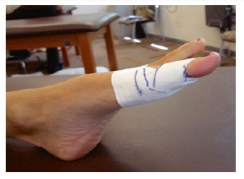 双脚趾对称疼痛,大脚趾痛鉴别诊断