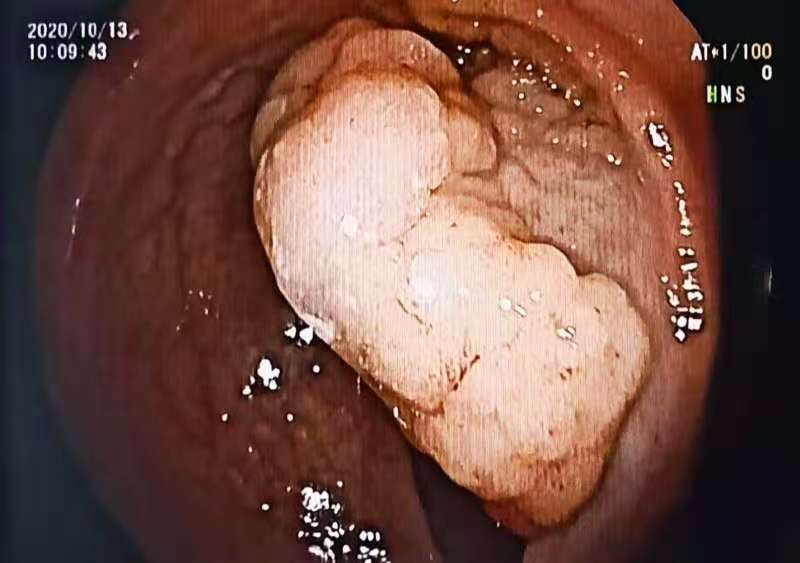 大同守佳消化病医院消化内科，行内镜黏膜下剥离术，成功切除4厘米早期直肠癌