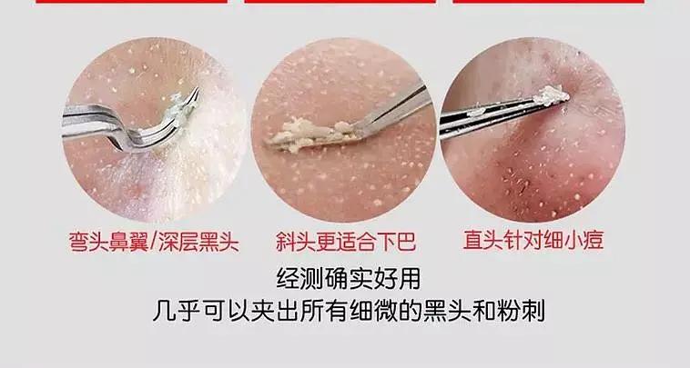 黑头可以用什么方法彻底清除,消除黑头简单有效的方法