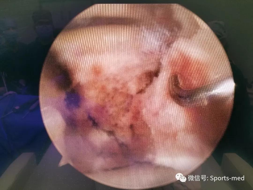 距骨软骨损伤的关节镜治疗,距骨软骨损伤关节镜手术