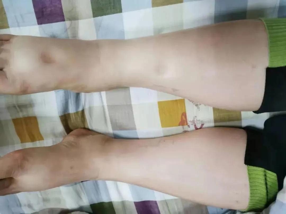 尿泡多是什么病的前兆,尿泡是肾出问题了吗