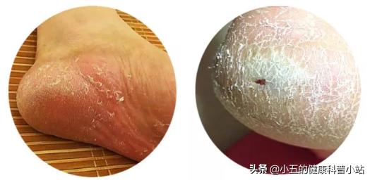 足癣瘙痒用什么药膏,脚丫溃烂水泡型足癣最怕的克星