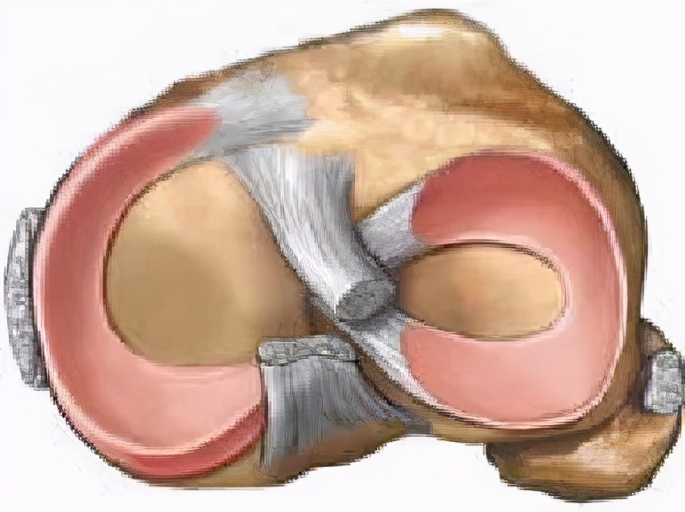 治疗半月板损伤最好的运动办法,运动导致半月板损伤很后悔