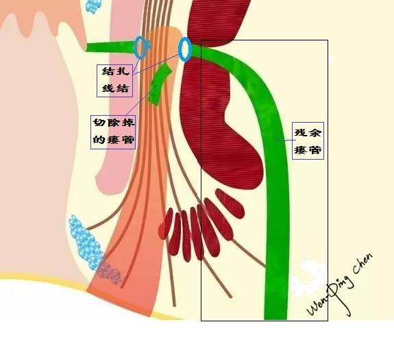 肛瘘lift手术天津哪有医院使用,北京哪家医院能做lift肛瘘手术