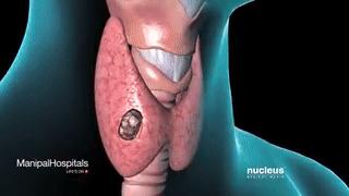 身上痒一检查竟是癌！皮肤出现小红疹，别大意！赶紧去检查甲状腺