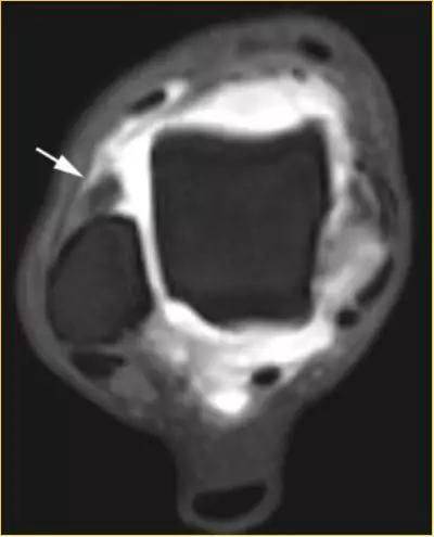 踝关节撞击症问诊,踝关节撞击综合征的x线表现