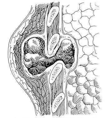 脊柱结核是怎么回事,健康科普不该被忽视的脊柱结核