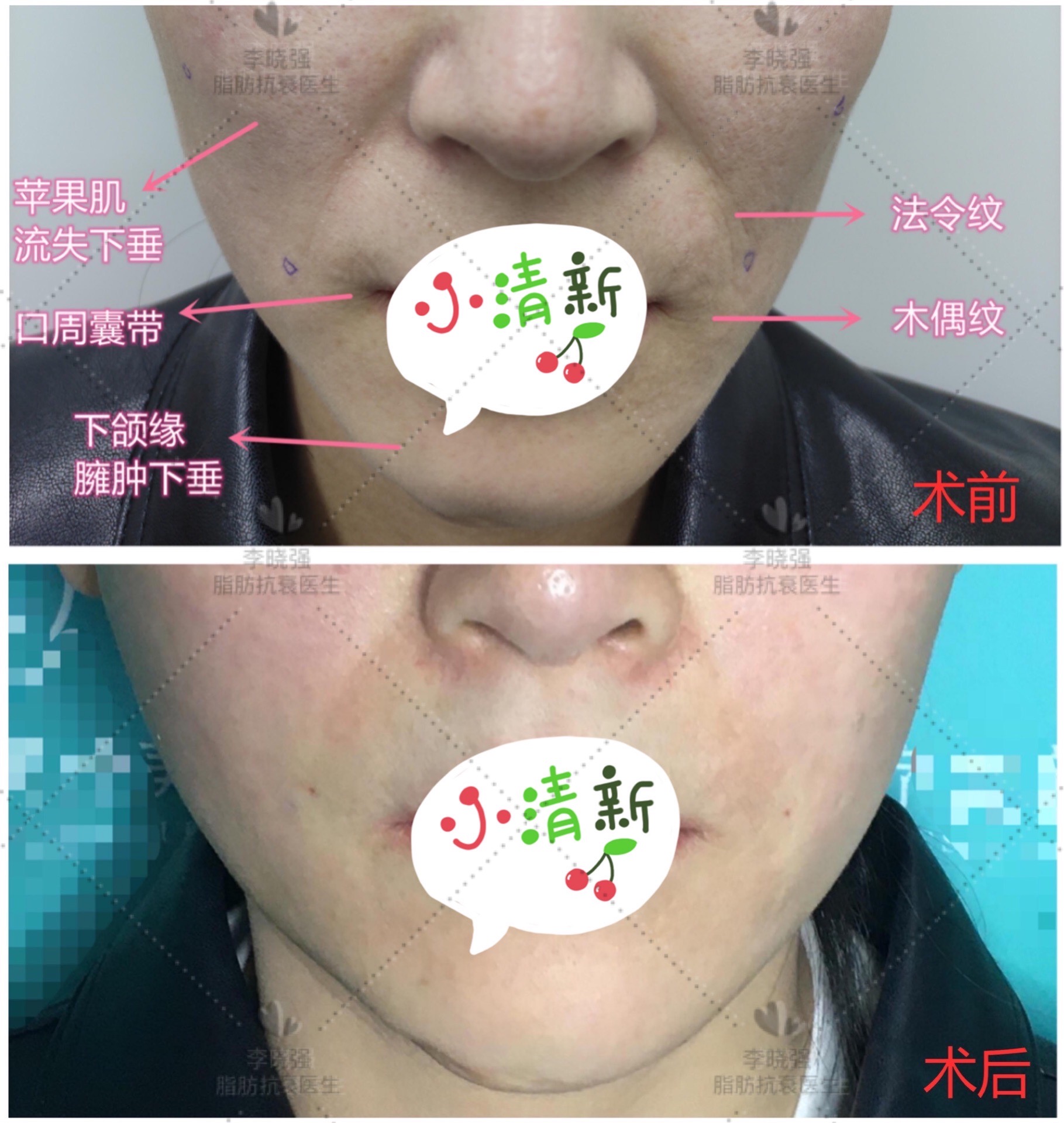 注射玻尿酸和肉毒素除皱皮肤紫红,肉毒素除皱后可以做玻尿酸填充吗