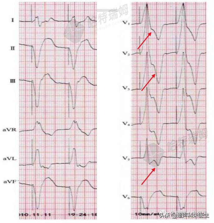 t波倒置诊断,t波倒置如何区分严重程度