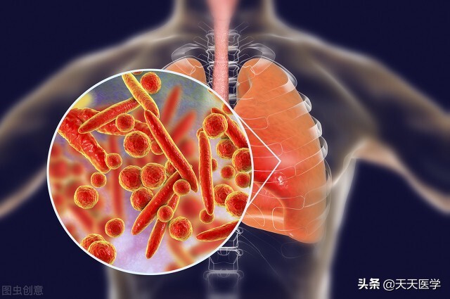 儿童肺炎支原体肺炎临床症状,支原体肺炎和衣原体肺炎哪个好治