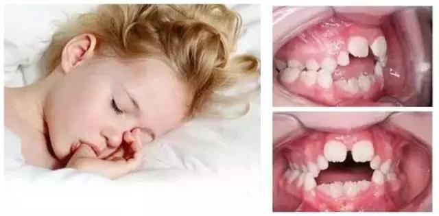 mrc矫正器小孩子晚上不愿意咬,mrc儿童牙齿矫正