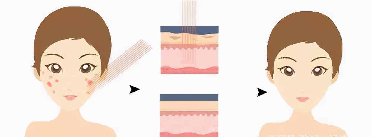 用维生素e是否可以祛痘,用维生素e可以祛斑吗