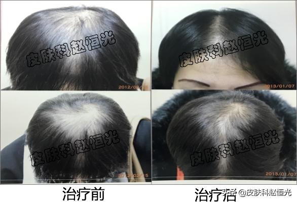 女生头顶头发越来越少了怎么办,头顶头发变细是脱发的前兆吗