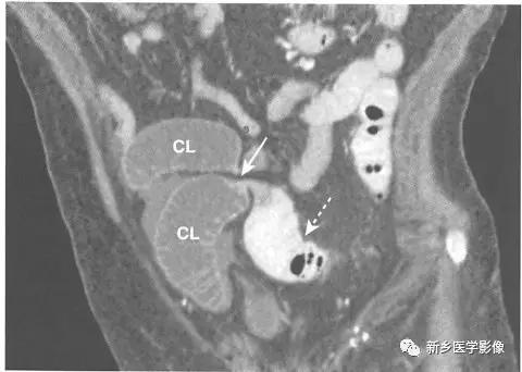 辨识肠梗阻,肠梗阻死亡前兆