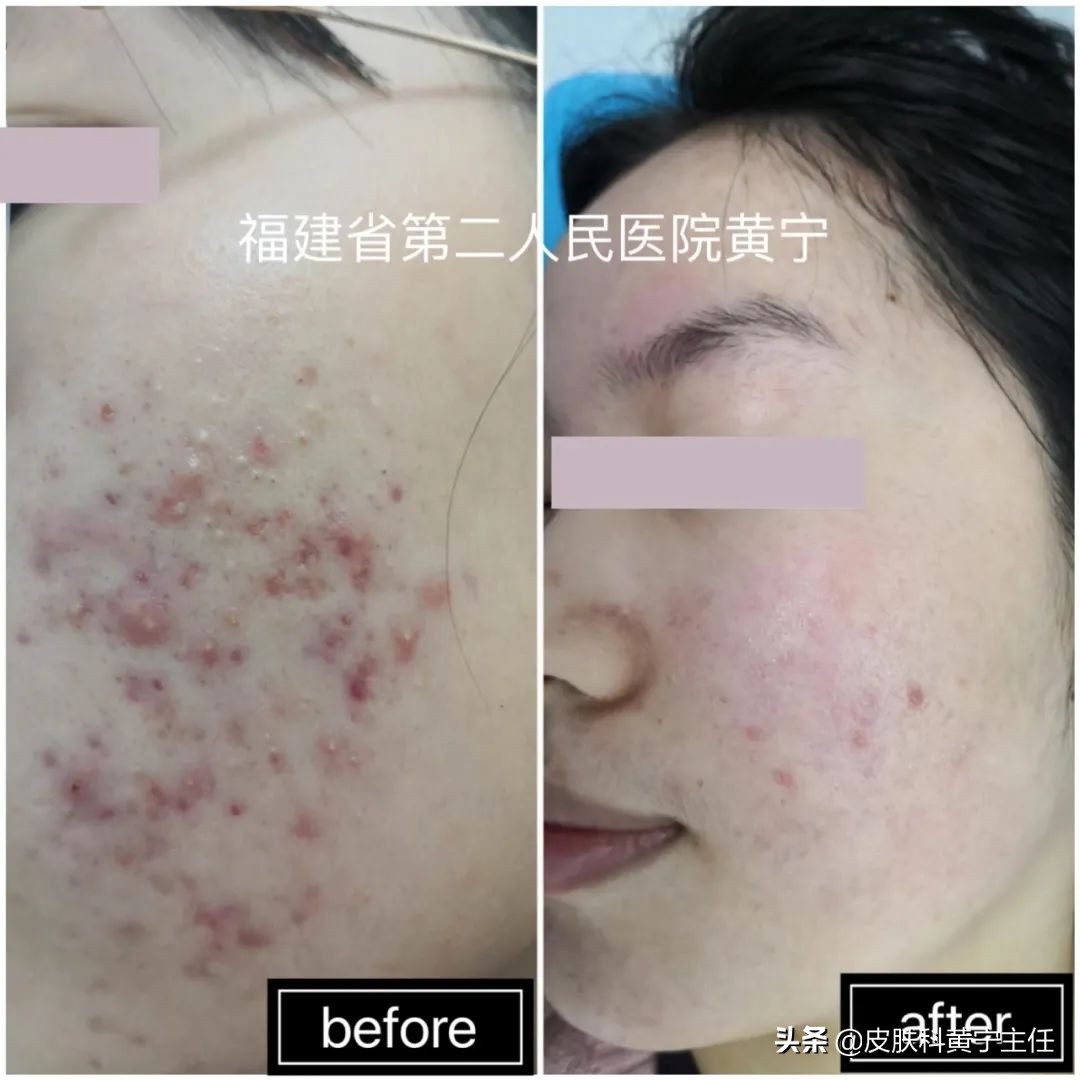 宅家的1个多月都没化妆，竟然还爆痘