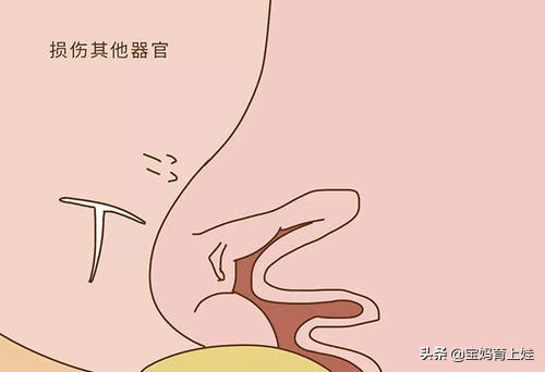 树袋宝宝：避孕环危害女性健康？一起来了解一下