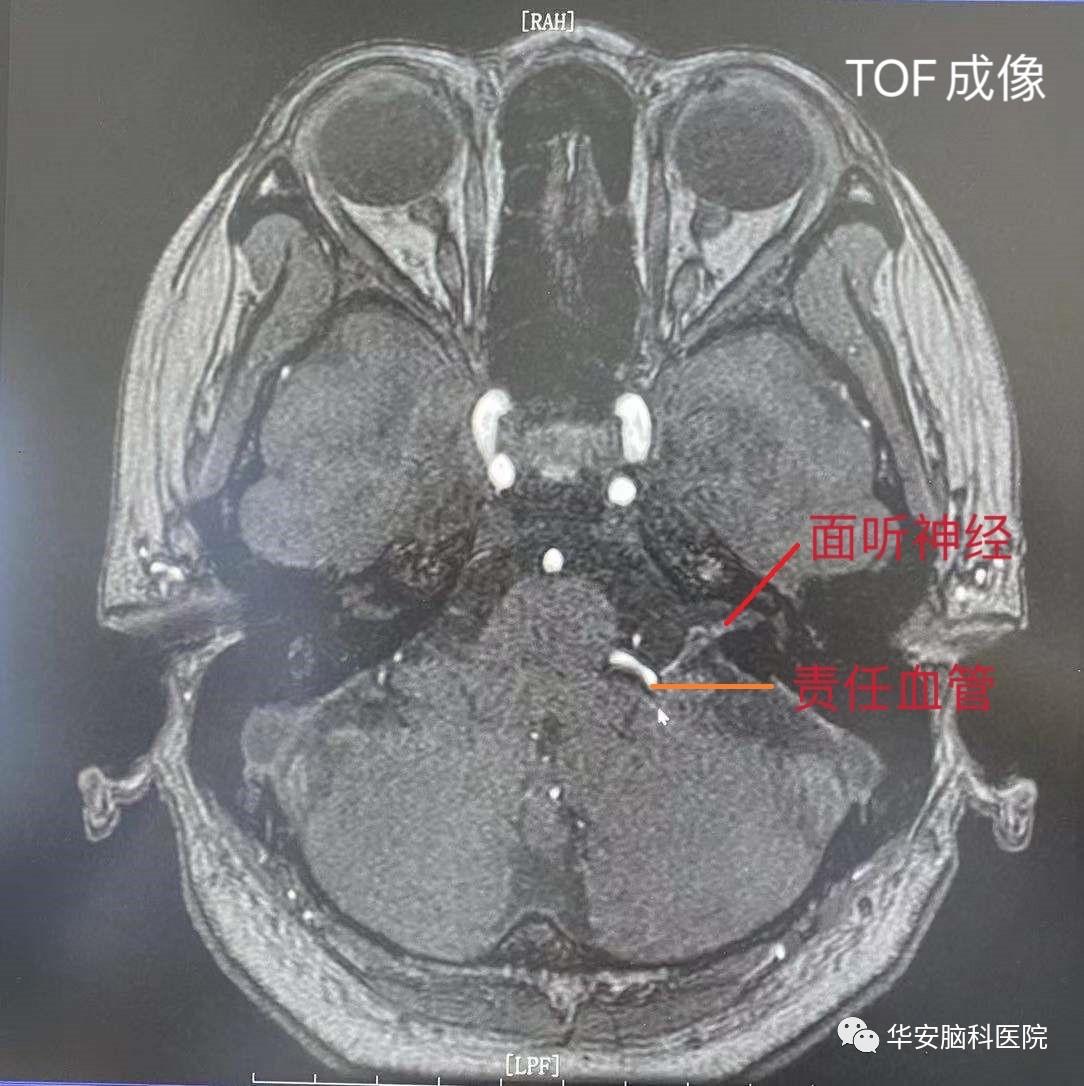 面神经显微血管减压手术,面肌痉挛显微减压术