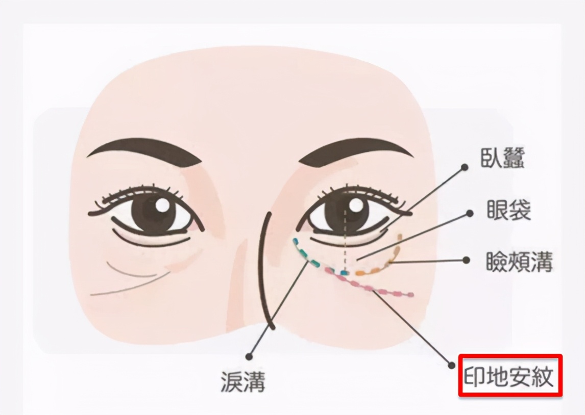 做眶隔释放眼袋后出现印第安纹,去眼袋出现印第安纹