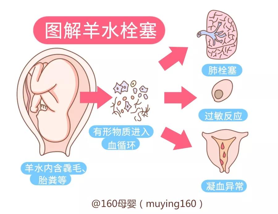 手术室产妇大出血抢救预案,产妇大出血导致胎儿轻微窒息