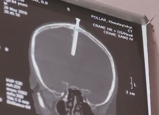 男子与家人激吵欲自杀，竟向头钉入2枚6厘米长钉，结果非同寻常