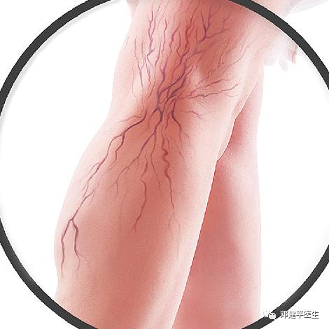 什么是毛细血管扩张,什么是毛细血管