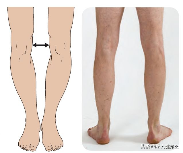 o型腿怎么改善效果最好,怎么样改善o型腿又快又有效