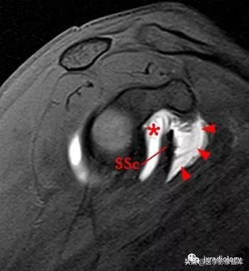 肩关节滑膜解剖,肩关节周围肌肉解剖
