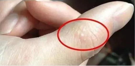 手上长水泡很痒怎么治疗,手上长冻疮又痒又痛又肿怎么办