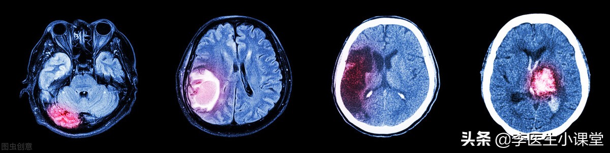 家人脑出血了安全了怎么安慰,家人突发脑溢血的急救措施