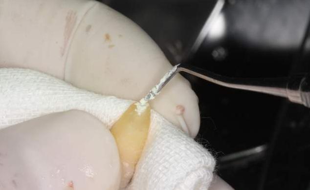 牙齿意外掉落可以救回来吗,牙齿意外脱落3小时可重新装上吗