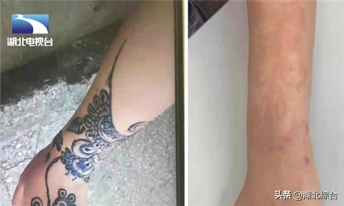 女子非洲旅游手绘纹身，不料红肿发痒患皮炎，医生：小心传染艾滋