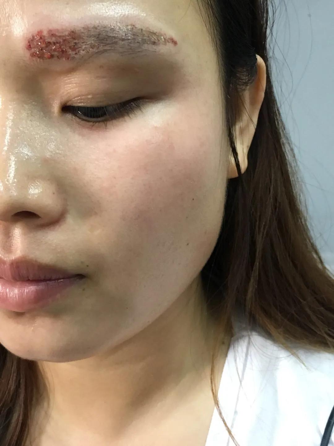 遗传性雀斑食疗方法,遗传性雀斑祛斑霜