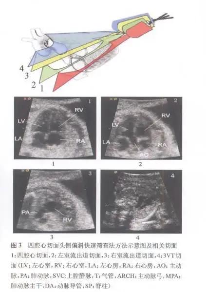 干货分享丨胎儿心脏畸形产前超声筛查与诊断策略
