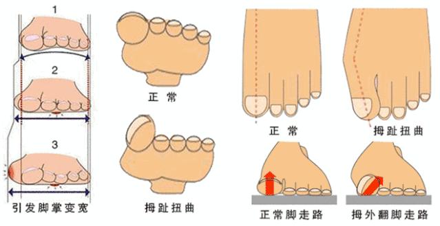 扁平足穿没有足底支撑的鞋,如何改善扁平足穿鞋的效果