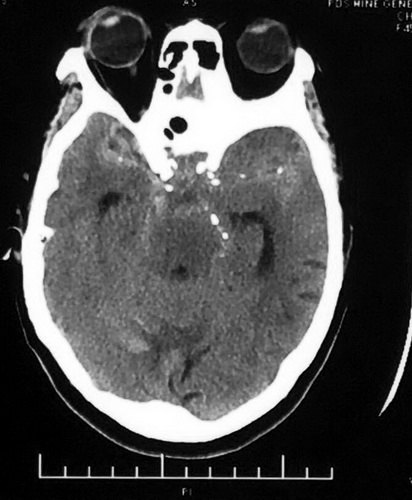 颅内巨大动脉瘤首选治疗技术,大脑中动脉动脉瘤闭塞的介入治疗