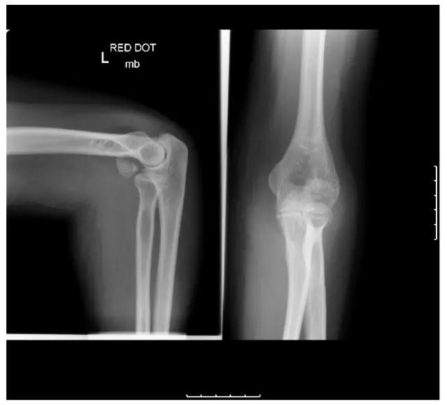 所有骨折都叫什么名字,骨折的名称有哪些