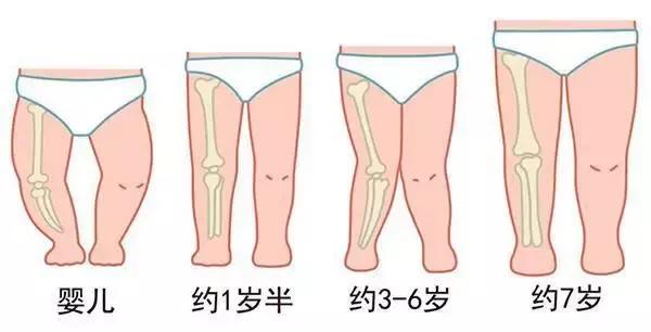 宝宝腿什么样是正常的,婴儿腿弯是o型腿吗