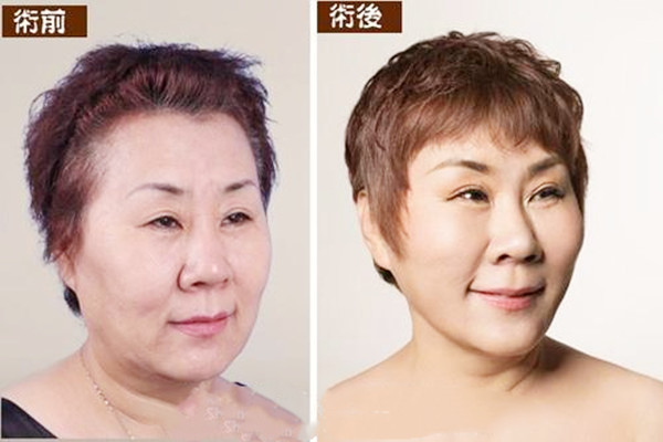 拉皮去皱手术的副作用,拉皮美容除皱有效果吗