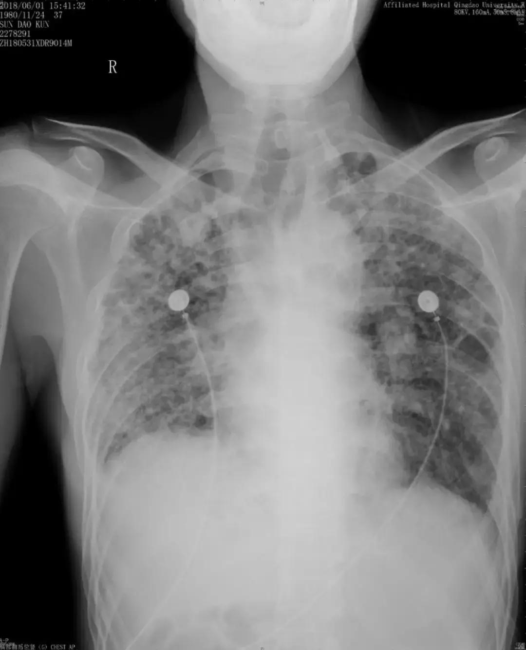 肺纤维化病例,肺纤维化手指甲发紫还能活多久