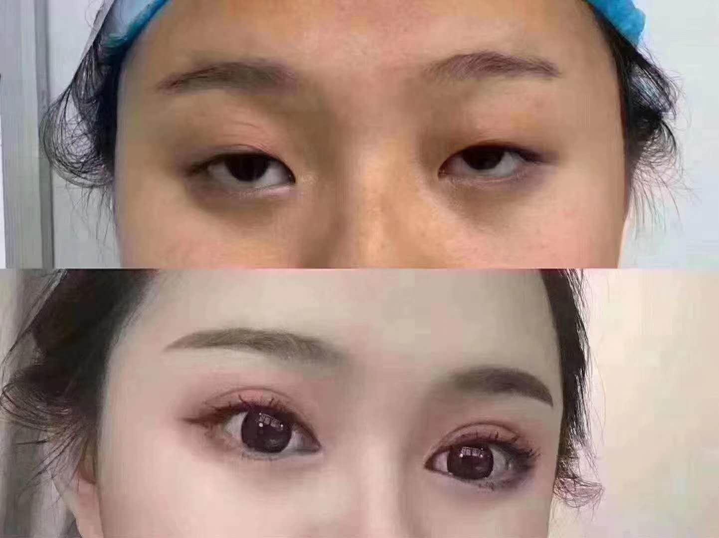 不建议做双眼皮的三种情况,为什么不建议做双眼皮