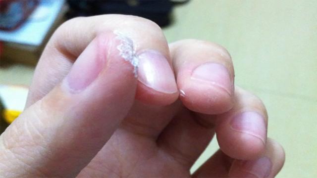 3岁男孩误食502胶水，父亲的做法医生忍不住称赞