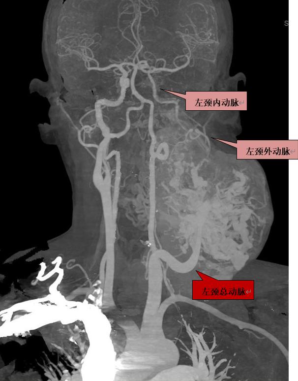 颈部肿块为什么有80%是肿瘤,颈部肿块1年没有变化