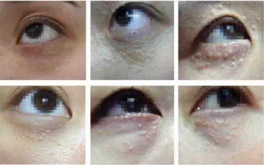 长了汗管瘤容易长皱纹,为什么会长汗管瘤和脂肪粒