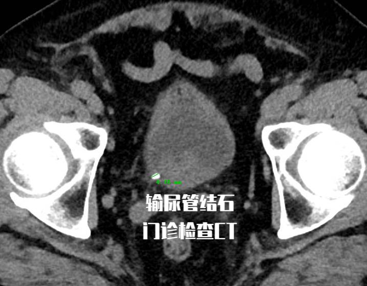 三毫米泌尿结石,泌尿系结石4个症状