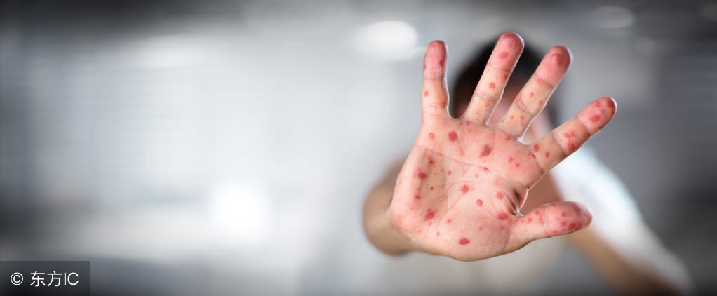 儿童手足口病发烧怎么治,儿童手足口病发热怎么办