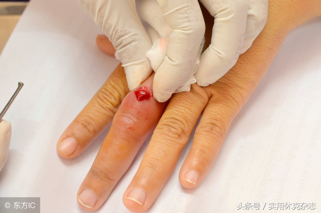 脓毒性休克与感染性休克的鉴别 (脓毒性休克要求多长时间纠正休克)