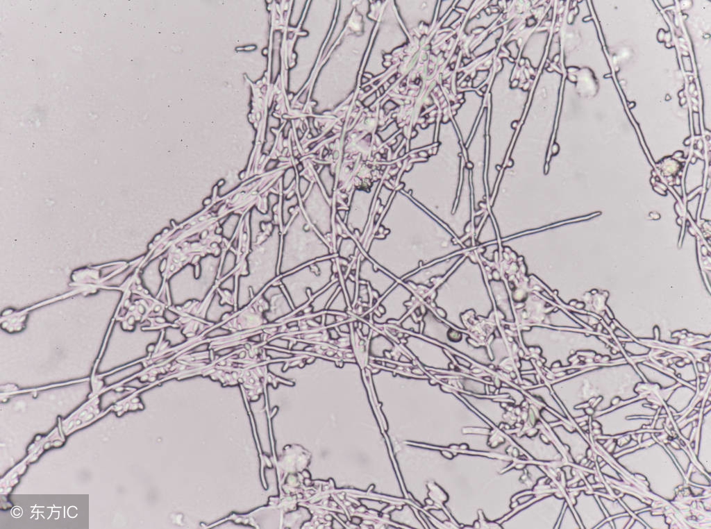 生殖器念珠菌病的临床症状是什么,患生殖器念珠菌病怎么办