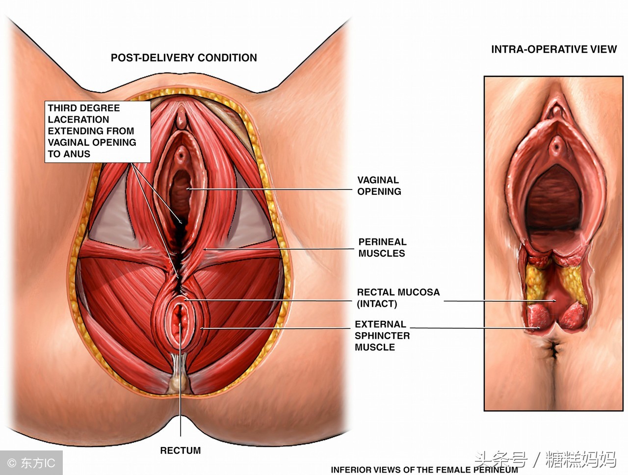 顺产如果被侧切，宝妈应该怎么护理伤口